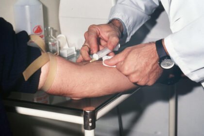 analisis genetico permite deteccion temprana del parkinson antes de manifestaciones