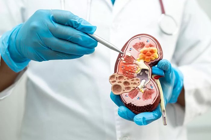 enfermedad renal cronica novena causa de muerte registra incremento del