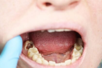 La mala salud bucal incrementa hasta 86% el riesgo de derrame cerebral, según estudios científicos