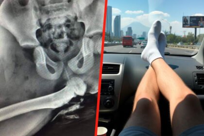 Evaluación de los riesgos de viajar con los pies en el tablero a baja velocidad