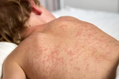 secretaria de salud de cdmx emite alerta por nuevos casos