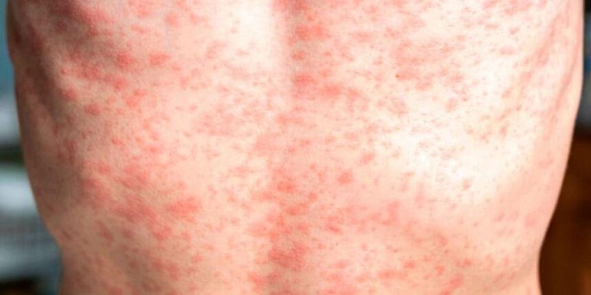 Ciudad de México: situación global y recomendaciones oficiales sobre vacunación