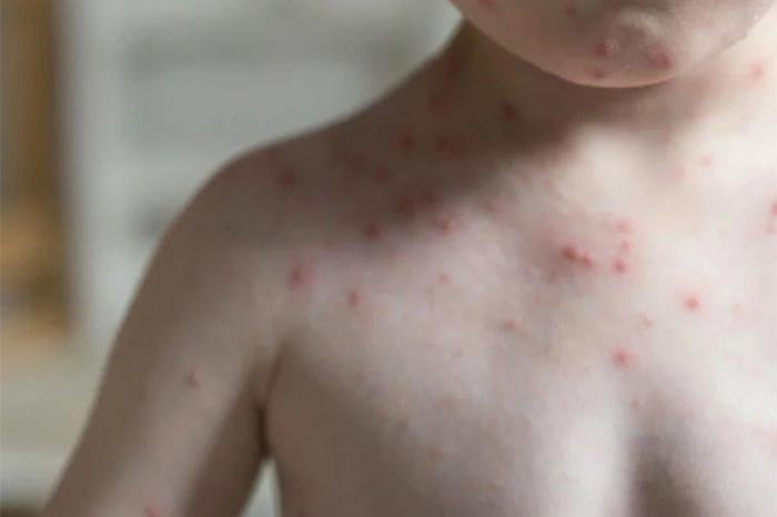 Michoacán y Tlaxcala registran dos muertes; 28 fallecidos por sarampión en México