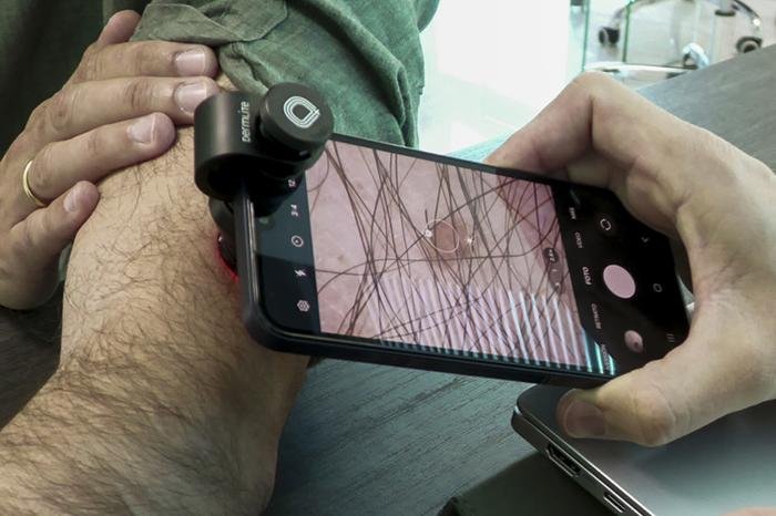 UNAM investiga melanoma acral en Ciudad de México, frecuente en el país