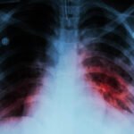 Michoacán registra 530 casos de tuberculosis en dos años