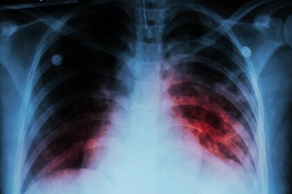 Michoacán registra 530 casos de tuberculosis en dos años